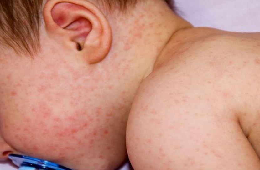 দেশে ২০ দিনে হাম সন্দেহে ৯৮ শিশুর মৃত্যু