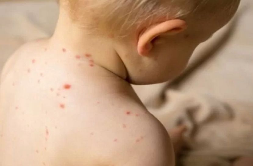 হাম ও হামের উপসর্গ নিয়ে দেশে আরও ৭ শিশুর মৃত্যু