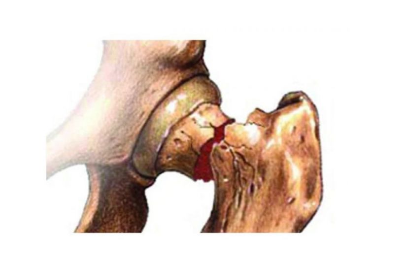 হাড়ক্ষয় রোগ: জনস্বাস্থ্যে নীরব সংকটের সতর্ক বার্তা