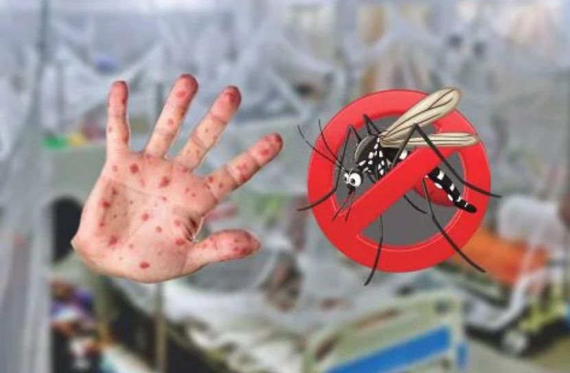 হাম-ডেঙ্গুর উপসর্গে বিভ্রান্তি, বাড়ছে জটিলতা
